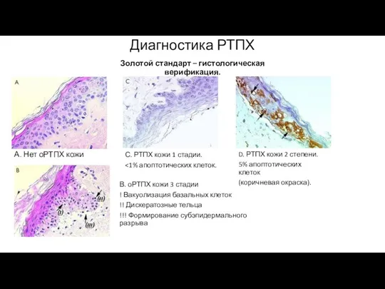 Золотой стандарт – гистологическая верификация. А. Нет оРТПХ кожи Диагностика