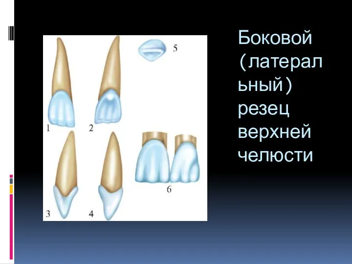 Боковой (латеральный) резец верхней челюсти