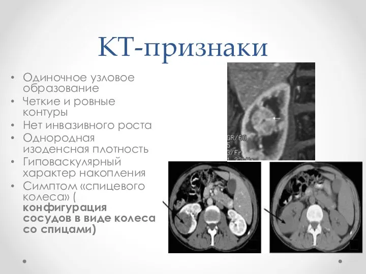 КТ-признаки Одиночное узловое образование Четкие и ровные контуры Нет инвазивного