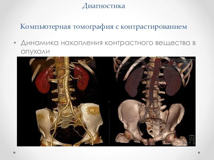 Диагностика Компьютерная томография с контрастированием Динамика накопления контрастного вещества в опухоли