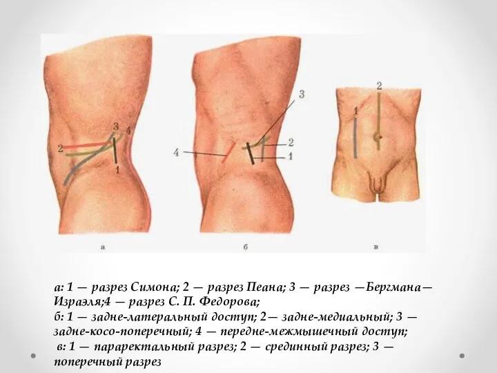 а: 1 — разрез Симона; 2 — разрез Пеана; 3 — разрез —Бергмана—Израэля;4