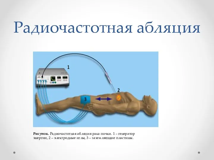 Радиочастотная абляция Рисунок. Радиочастотная абляция рака почки. 1 – генератор