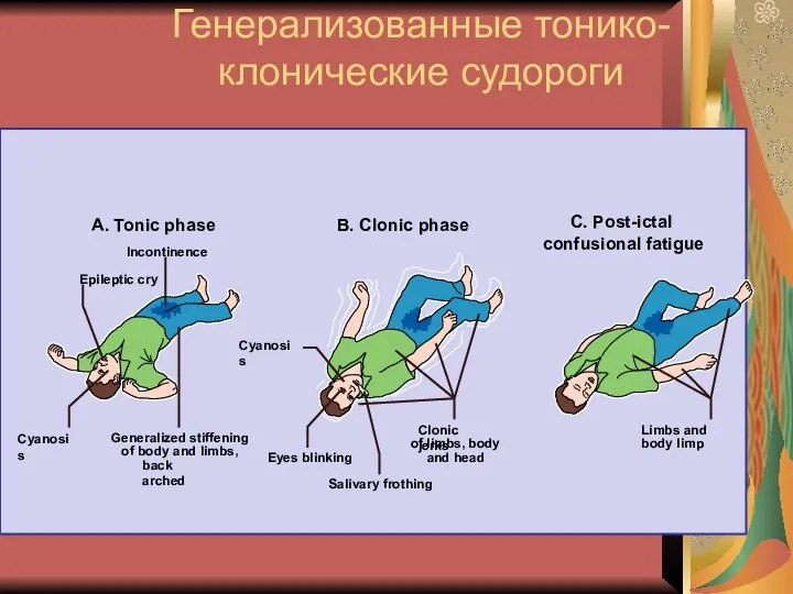 Генерализованные тонико-клонические судороги Incontinence Cyanosis A. Tonic phase B. Clonic