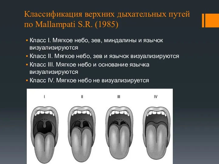 Классификация верхних дыхательных путей по Mallampati S.R. (1985) Класс I.