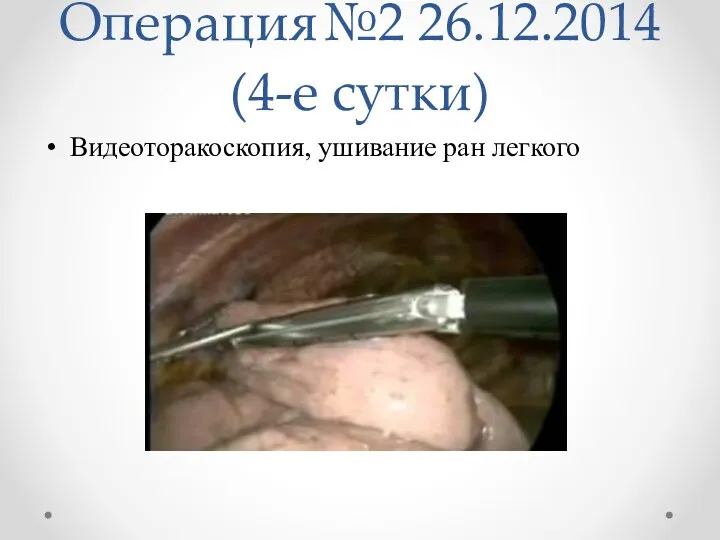 Операция№2 26.12.2014 (4-е сутки) Видеоторакоскопия, ушивание ран легкого