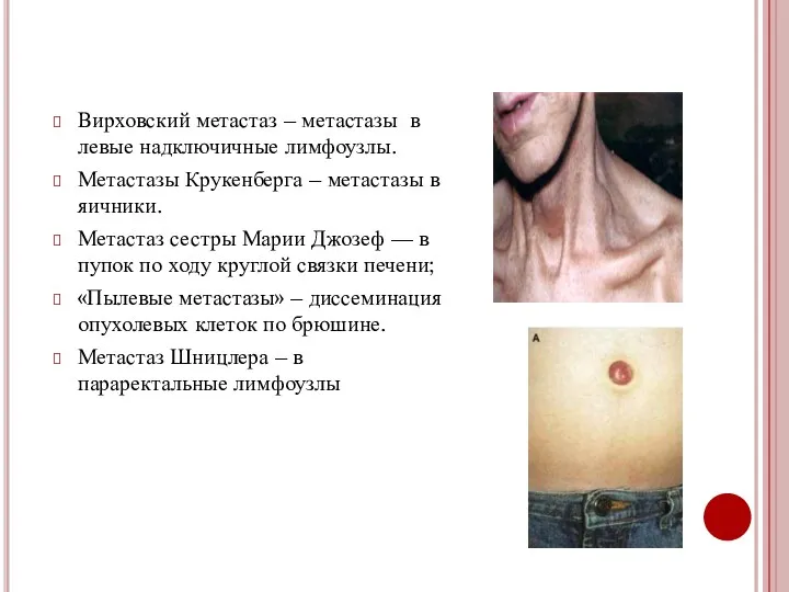 Вирховский метастаз – метастазы в левые надключичные лимфоузлы. Метастазы Крукенберга