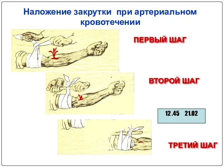 Наложение закрутки при артериальном кровотечении ПЕРВЫЙ ШАГ ВТОРОЙ ШАГ ТРЕТИЙ ШАГ