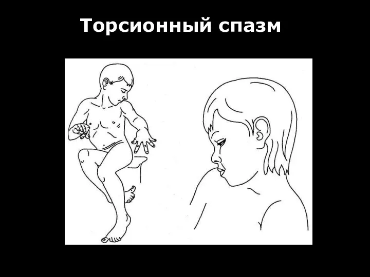 Торсионный спазм