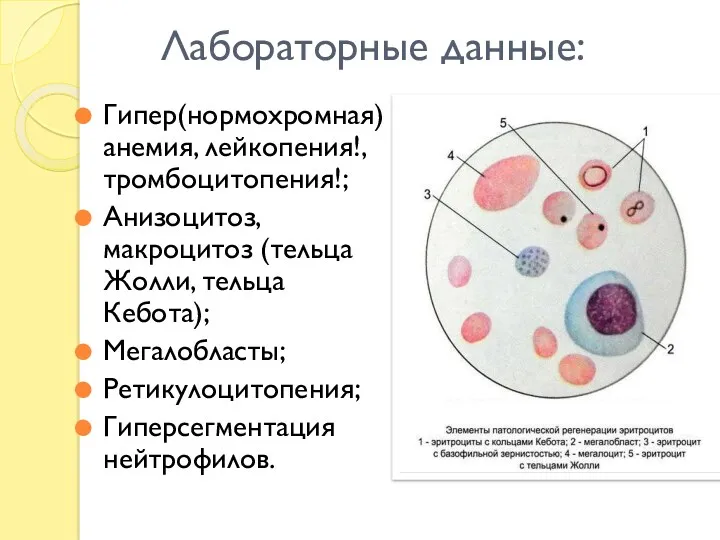 Лабораторные данные: Гипер(нормохромная) анемия, лейкопения!, тромбоцитопения!; Анизоцитоз, макроцитоз (тельца Жолли, тельца Кебота); Мегалобласты; Ретикулоцитопения; Гиперсегментация нейтрофилов.