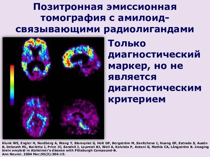 Позитронная эмиссионная томография с амилоид-связывающими радиолигандами Только диагностический маркер, но не является диагностическим
