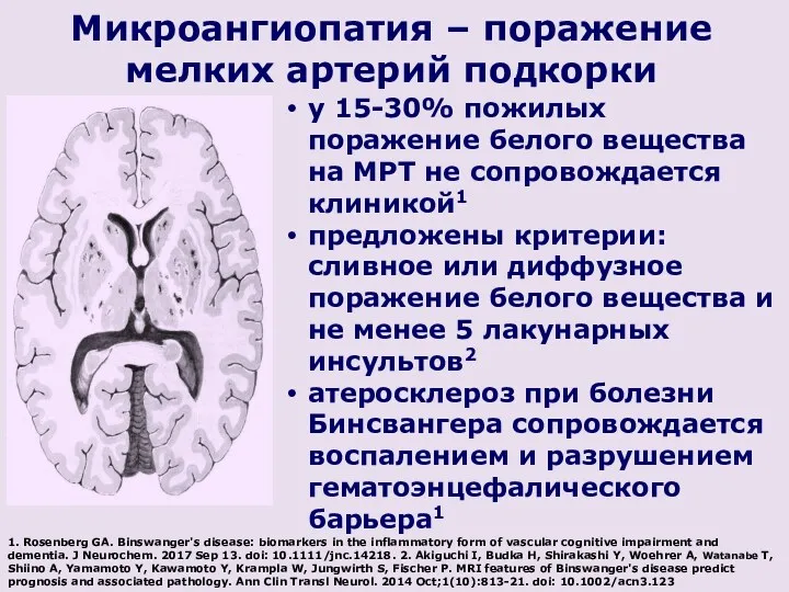 Микроангиопатия – поражение мелких артерий подкорки у 15-30% пожилых поражение белого вещества на