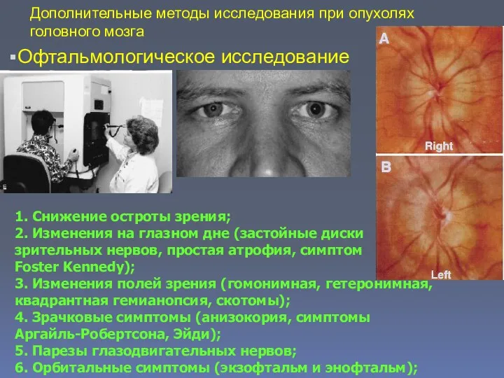 Дополнительные методы исследования при опухолях головного мозга Офтальмологическое исследование 1. Снижение остроты зрения;