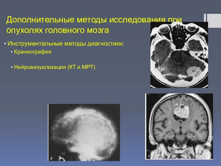 Дополнительные методы исследования при опухолях головного мозга Инструментальные методы диагностики: Краниография Нейровизуализация (КТ и МРТ)