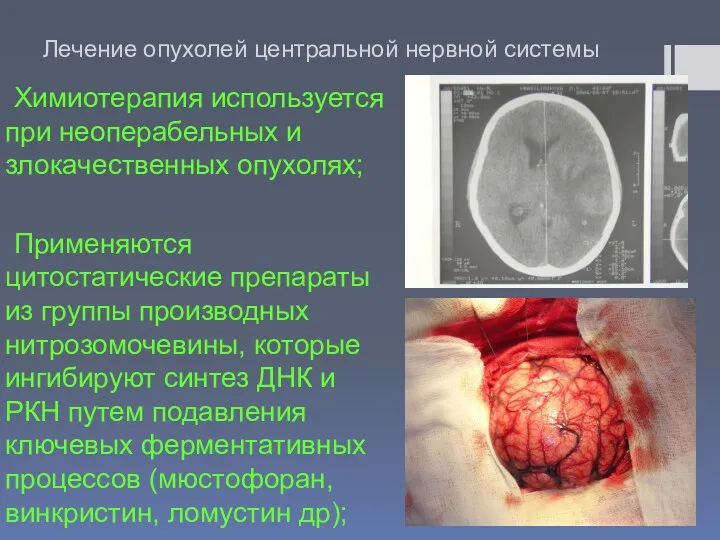 Лечение опухолей центральной нервной системы Химиотерапия используется при неоперабельных и злокачественных опухолях; Применяются