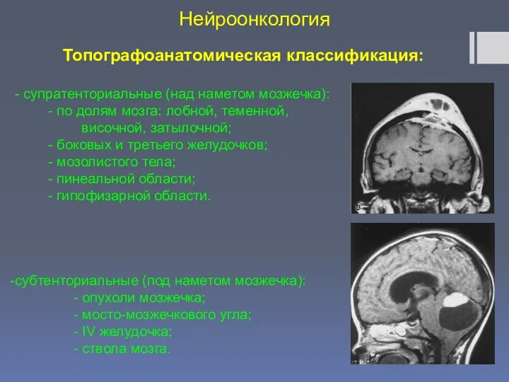 Нейроонкология Топографоанатомическая классификация: - супратенториальные (над наметом мозжечка): - по