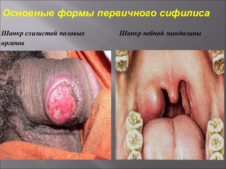 Основные формы первичного сифилиса Шанкр слизистой половых Шанкр небной миндалины органов