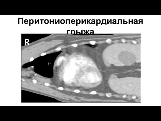 Перитониоперикардиальная грыжа R