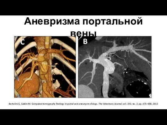 Аневризма портальной вены Bertolini G, Caldin M. Computed tomography findings in portal vein