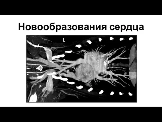 Новообразования сердца