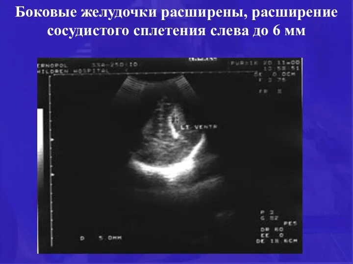 Боковые желудочки расширены, расширение сосудистого сплетения слева до 6 мм