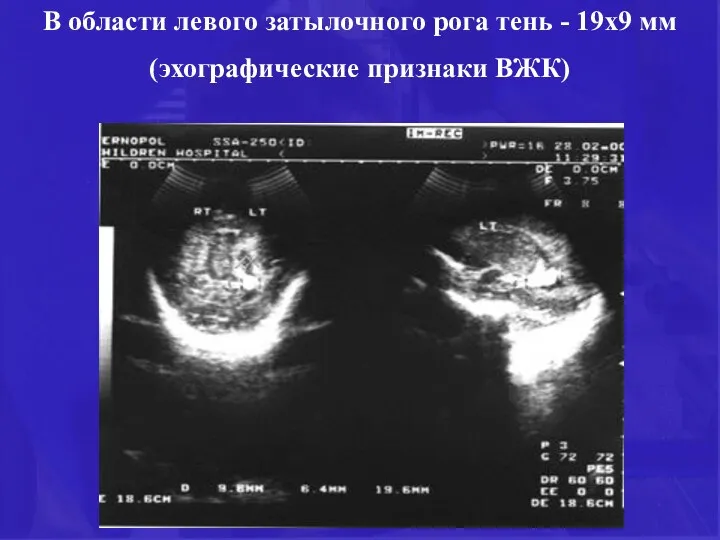 В области левого затылочного рога тень - 19х9 мм (эхографические признаки ВЖК)