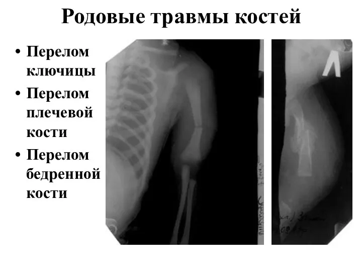 Родовые травмы костей Перелом ключицы Перелом плечевой кости Перелом бедренной кости