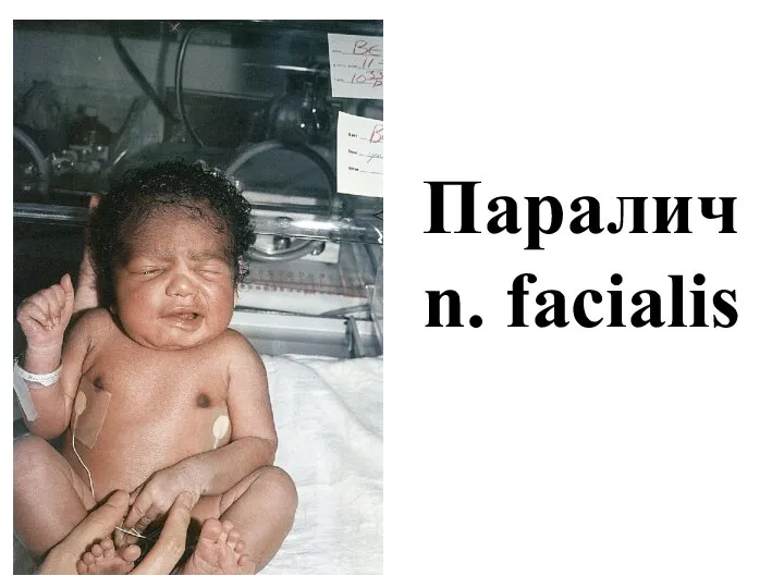 Паралич n. facialis