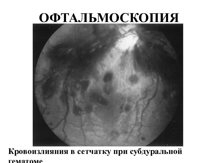 ОФТАЛЬМОСКОПИЯ Кровоизлияния в сетчатку при субдуральной гематоме