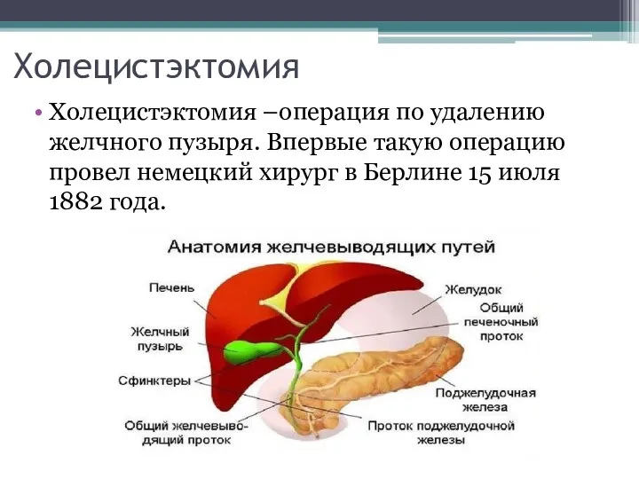 Холецистэктомия Холецистэктомия –операция по удалению желчного пузыря. Впервые такую операцию