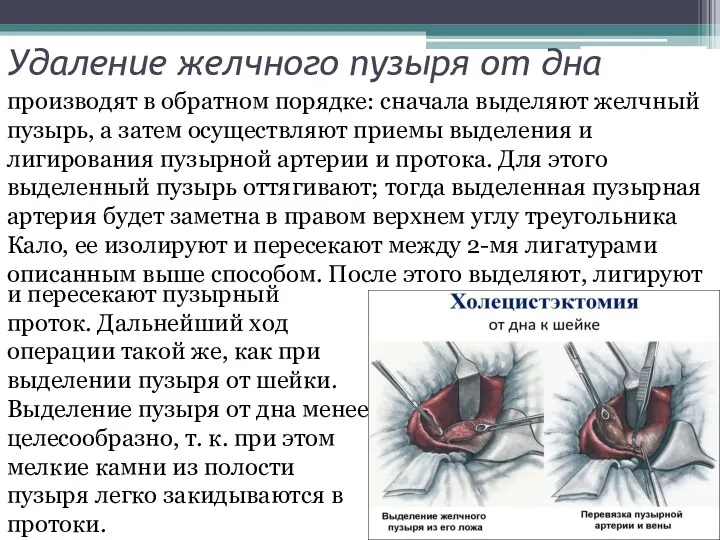 Удаление желчного пузыря от дна производят в обратном порядке: сначала