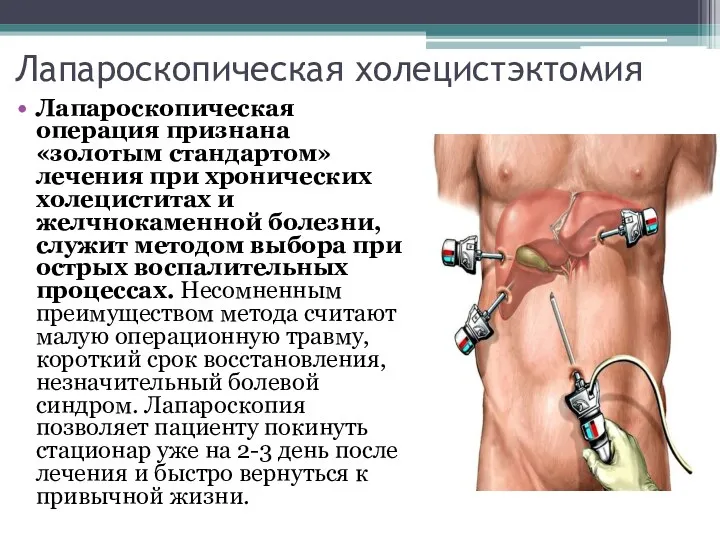 Лапароскопическая холецистэктомия Лапароскопическая операция признана «золотым стандартом» лечения при хронических