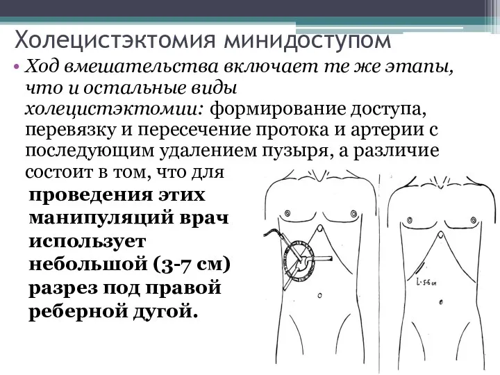 Холецистэктомия минидоступом Ход вмешательства включает те же этапы, что и