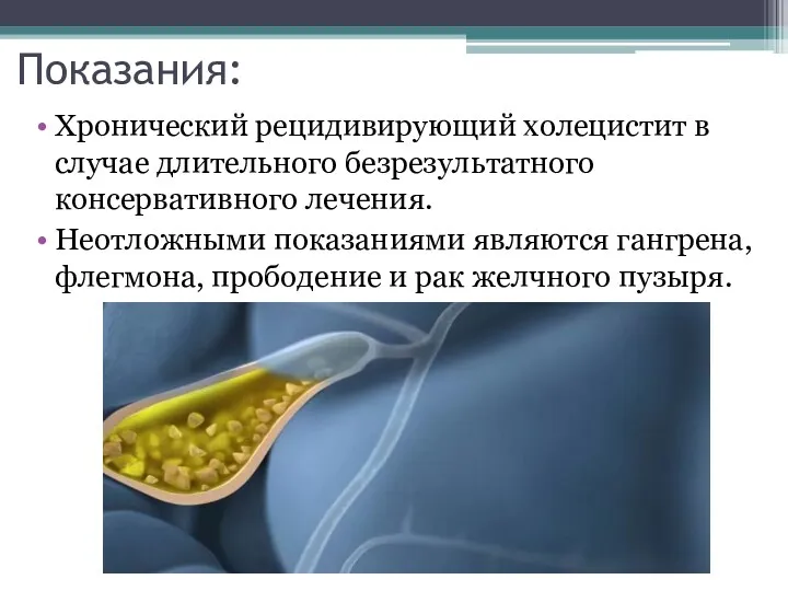 Показания: Хронический рецидивирующий холецистит в случае длительного безрезультатного консервативного лечения.