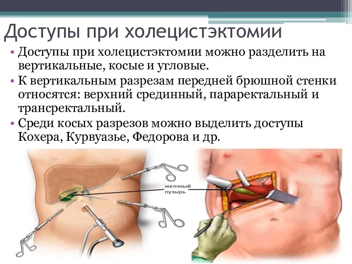 Доступы при холецистэктомии Доступы при холецистэктомии можно разделить на вертикальные,