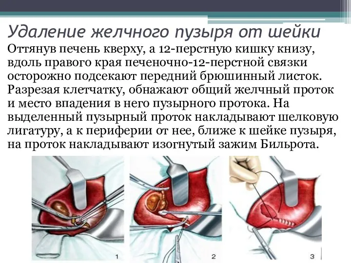 Удаление желчного пузыря от шейки Оттянув печень кверху, а 12-перстную