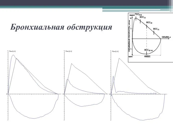 Бронхиальная обструкция