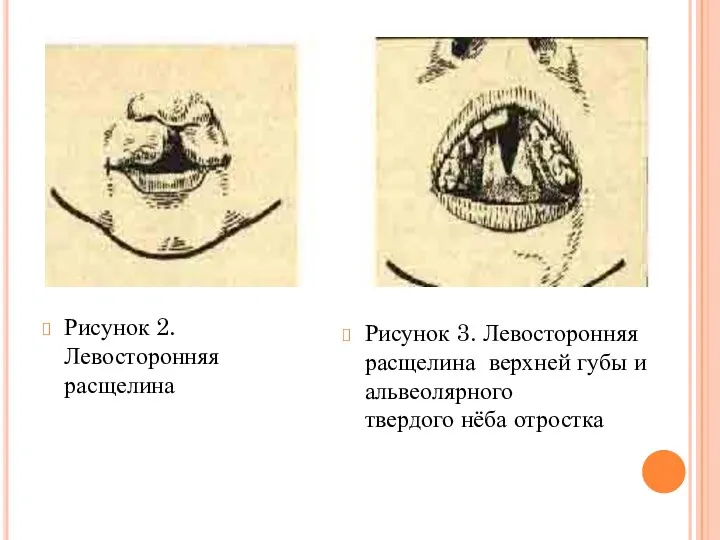 Рисунок 2. Левосторонняя расщелина Рисунок 3. Левосторонняя расщелина верхней губы и альвеолярного твердого нёба отростка
