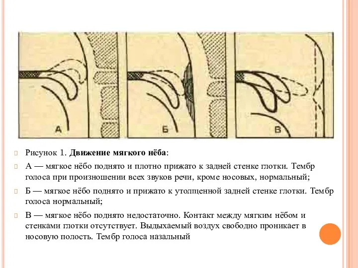 Рисунок 1. Движение мягкого нёба: А — мягкое нёбо поднято и плотно прижато