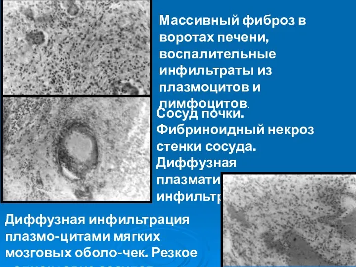 Массивный фиброз в воротах печени, воспалительные инфильтраты из плазмоцитов и лимфоцитов. Сосуд почки.