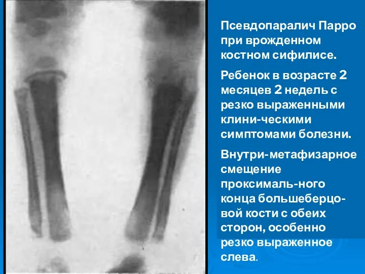 Псевдопаралич Парро при врожденном костном сифилисе. Ребенок в возрасте 2 месяцев 2 недель