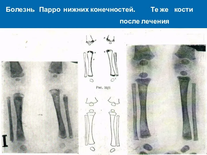 Болезнь Парро нижних конечностей. Те же кости после лечения