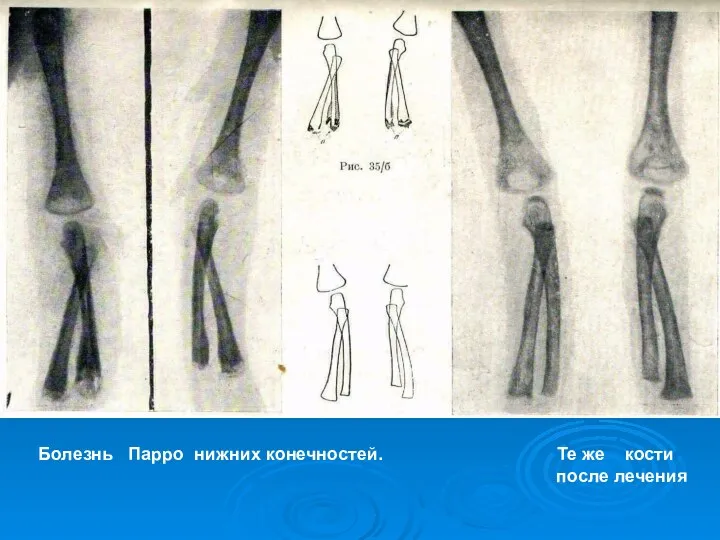 Болезнь Парро нижних конечностей. Те же кости после лечения
