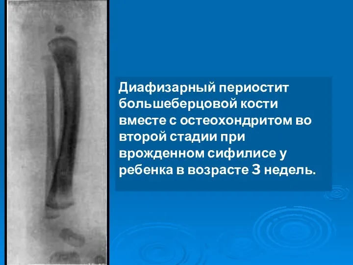 Диафизарный периостит большеберцовой кости вместе с остеохондритом во второй стадии при врожденном сифилисе