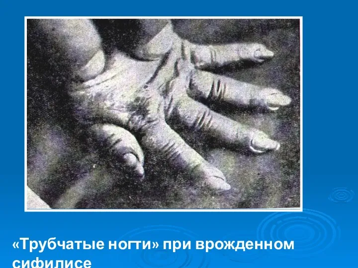 «Трубчатые ногти» при врожденном сифилисе