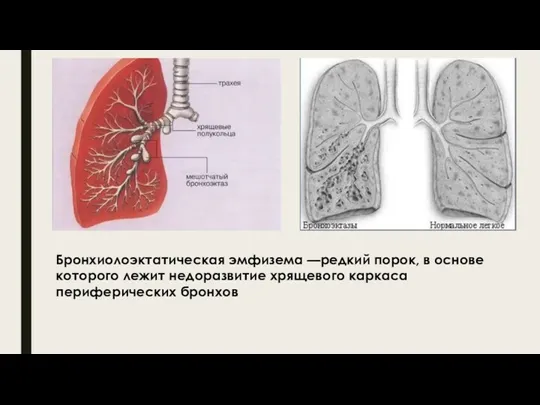 Бронхиолоэктатическая эмфизема —редкий порок, в основе которого лежит недоразвитие хрящевого каркаса периферических бронхов