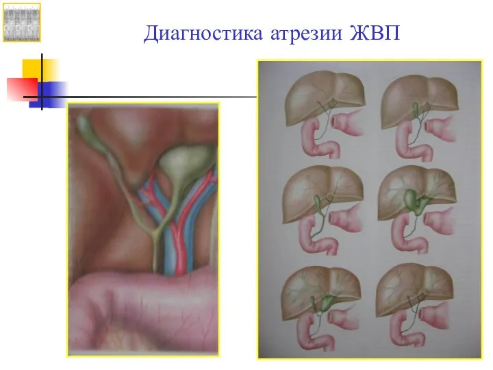 Диагностика атрезии ЖВП