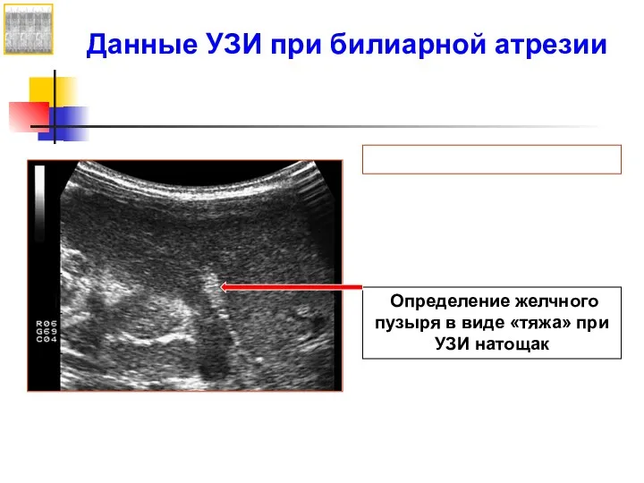 Определение желчного пузыря в виде «тяжа» при УЗИ натощак Данные УЗИ при билиарной атрезии