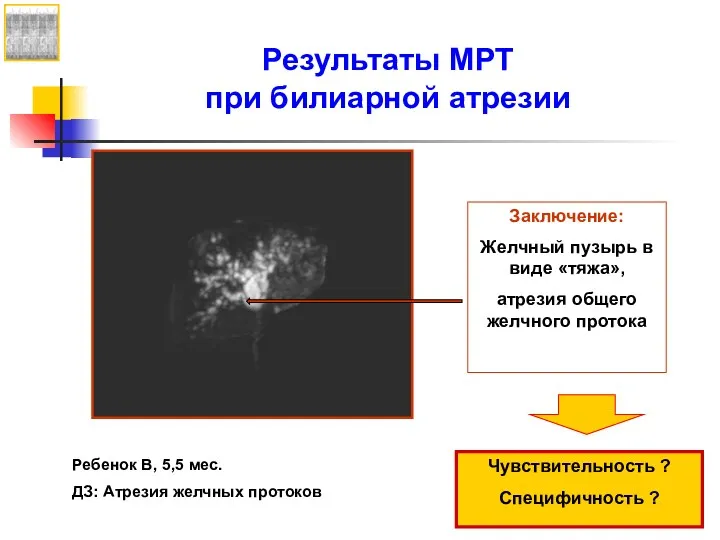 Результаты МРТ при билиарной атрезии Ребенок В, 5,5 мес. ДЗ: