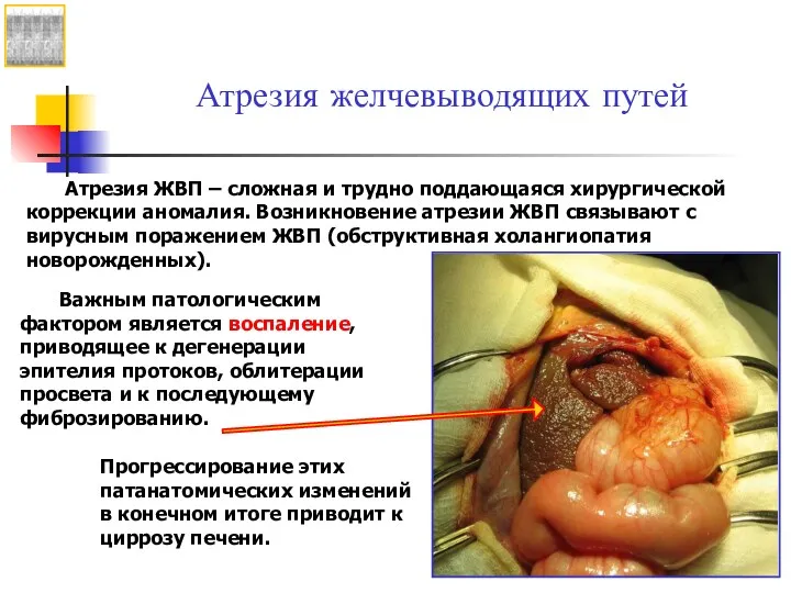 Атрезия желчевыводящих путей Атрезия ЖВП – сложная и трудно поддающаяся