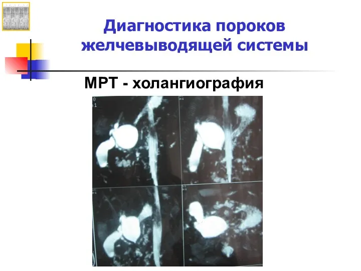 Диагностика пороков желчевыводящей системы МРТ - холангиография